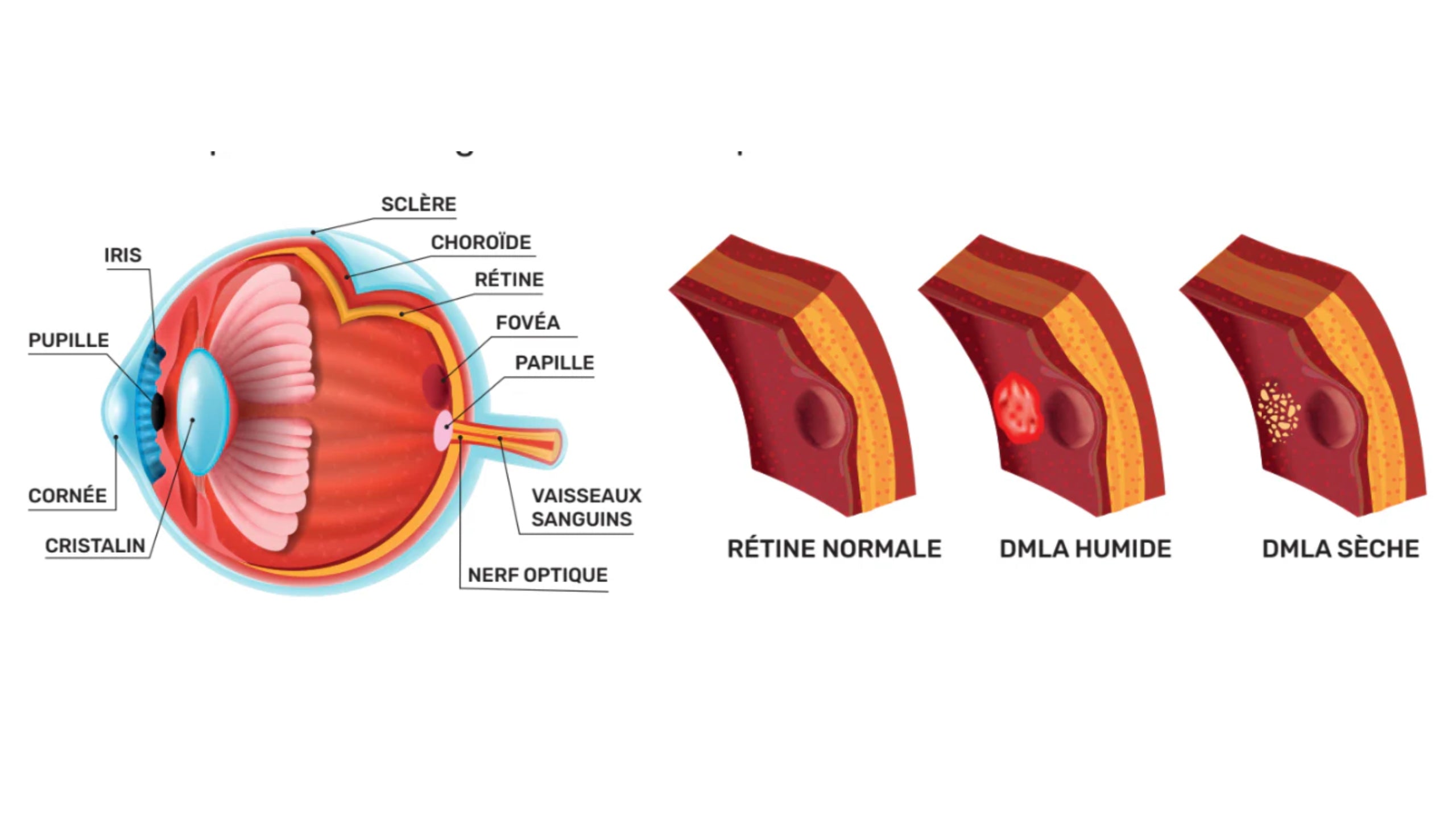 Qu'est-ce que la DMLA ?